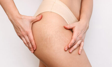 Rozstępy na skórze – jak usunąć
